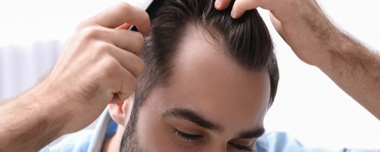 Male head with hair loss symptoms front side Stock Photo  Alamy