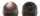 hair-transplantation-before-after (1)